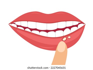 Mouth ulcer concept vector illustration on white background.