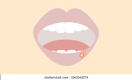 Mouth ulcers, dental hygiene problem.