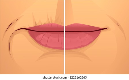 Mouth wrinkles, before-after. Vector illustration.