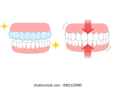 Mouthpiece and tooth wear and TCH stress temporomandibular joint disease