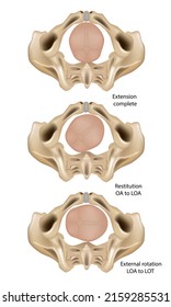 Сardinal movements of Childbirth. Foetus rotation onset of labour Extension complete, Restitution OA to LOA