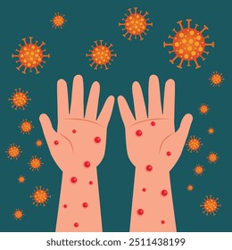 Mpox monkeypox virus deseas two hand with rash skin inflamation plague pandemic