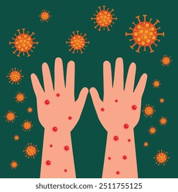 Mpox monkeypox virus deseas two hand with rash skin inflamation plague pandemic