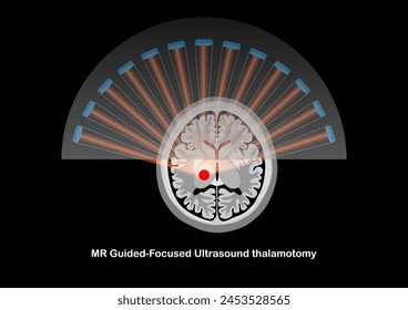 MR-geführte fokussierte Ultraschall-Thalamotomie zur Behandlung von Tremor bei Parkinson-Krankheit. 