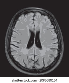 mri of the brain of an adult male on a black background