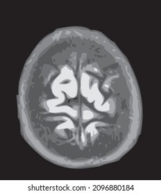 mri of the brain of an adult male on a black background