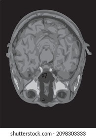 mri of the brain of an adult male on a black background