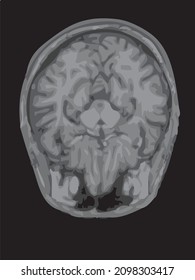 mri of the brain of an adult male on a black background