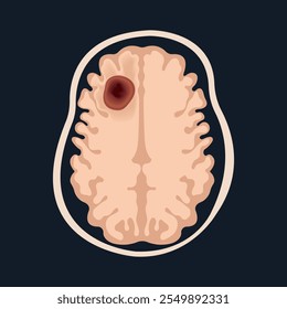 RM do cérebro mostra glioblastoma frontal. Conceito de câncer cerebral