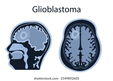 RM do cérebro mostra glioblastoma frontal. Conceito de câncer cerebral