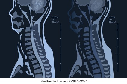 RM de la columna cervical con y sin contraste, RM con compresión bilateral de raíz C7, espondilosis cervical