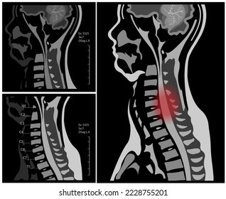 MRI of the cervical spine with and without contrast, MRI with bilateral C7 root compression, Cervical spondylosis