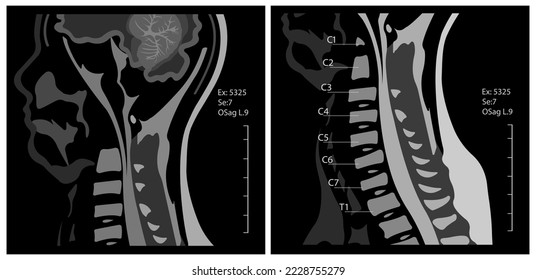 MRI of the cervical spine with and without contrast, MRI with bilateral C7 root compression, Cervical spondylosis