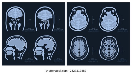 IMAGEN de resonancia magnética de un cerebro humano que muestra todas las manifestaciones principales de la esclerosis múltiple.