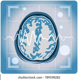 MRI - Magnetic Resonance Imaging - Illustration
