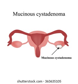 Mucinous cyst on the ovary. Cystadenoma. Ovary. Infographics. Vector illustration on isolated background.