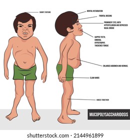 Mucopolysaccharidoses, are a group of rare (orphan) or low prevalence diseases considered degenerative in childhood.