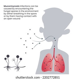 Mucormycosis black fungus infection in the lungs through inhaled spores