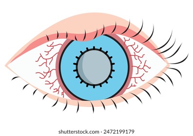 Mucous membrane pemphigoid,Cicatricial,chronic autoimmune causing blistering and scarring of the mucous membranes, including the eyes,Stevens-Johnson syndrom,ocular,Mooren's ulcer