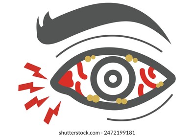 Mucous membrane pemphigoid,Cicatricial,chronic autoimmune causing blistering and scarring of the mucous membranes, including the eyes,Stevens-Johnson syndrom,ocular,Mooren's ulcer