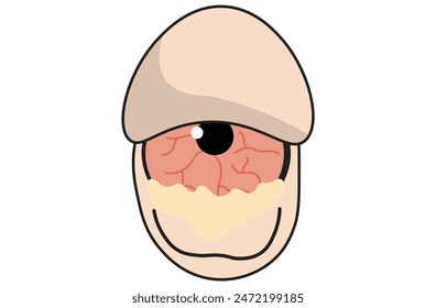 Mucous membrane pemphigoid,Cicatricial,chronic autoimmune causing blistering and scarring of the mucous membranes, including the eyes,Stevens-Johnson syndrom,ocular,Mooren's ulcer