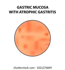 Mucous stomach with atrophic gastritis. Infographics. Vector illustration on isolated background