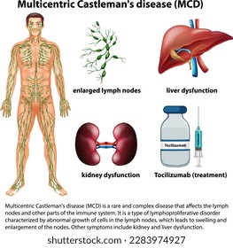 Multicentric Castlemans Disease (MCD) Infographic illustration