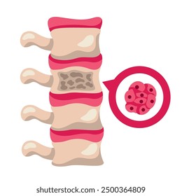 Mes de Concienciación del Mieloma Múltiple Aislado