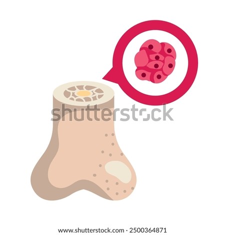 multiple myeloma bone awareness isolated