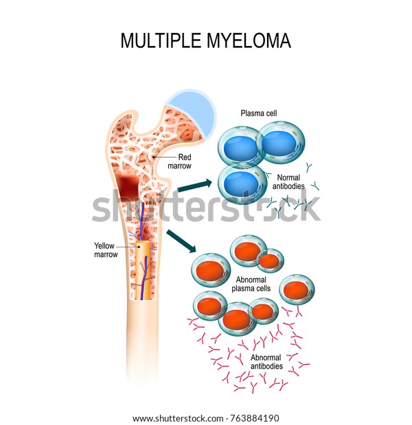 Multiple myeloma is a cancer
of the bone marrow. healthy plasma cells in the bone marrow mutate
and multiply uncontrollably.  malignant plasma cells produce a
paraprotein