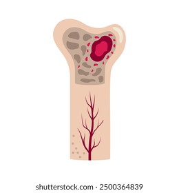 multiple myeloma disease awareness isolated