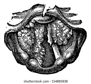 Multiple Papilloma of the Larynx, vintage engraved illustration. Usual Medicine Dictionary by Dr Labarthe - 1885