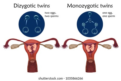 Multiple Pregnancy. Dizygotic And Monozygotic Twins, Embryo, Fetus In Uterus, Placenta, Umbilical Cord, Egg, Sperm. Vector Medical Illustration. Colored Image, White Background.