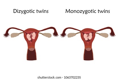 Multiple pregnancy. Dizygotic and monozygotic twins, embryo, fetus in uterus, placenta, umbilical cord. Vector flat medical illustration. Colored image, white background.