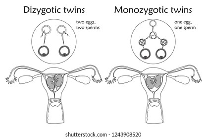 Multiple Pregnancy. Dizygotic And Monozygotic Twins, Embryo, Fetus In Uterus, Placenta, Umbilical Cord, Egg, Sperm. Vector Flat Medical Illustration. Thin Line Image, White Background.