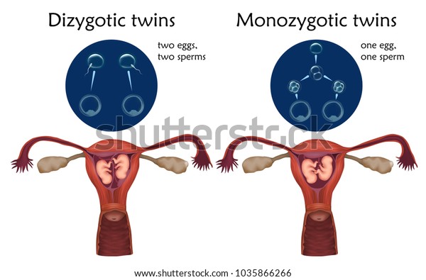Multiple\
pregnancy. Dizygotic and monozygotic twins, embryo, fetus in\
uterus, placenta, umbilical cord, egg, sperm. Vector medical\
illustration. Colored image, white\
background.