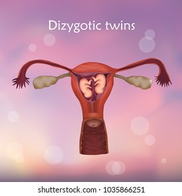 Multiple pregnancy. Dizygotic twins, embryo, fetus in uterus, placenta, umbilical cord. Vector medical illustration. Colored image, white background.