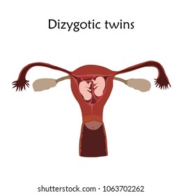 Multiple pregnancy. Dizygotic twins, embryo, fetus in uterus, placenta, umbilical cord. Vector flat medical illustration. Colored image, white background.