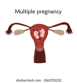 Multiple pregnancy, twins, embryo, fetus in uterus, placenta, umbilical cord. Vector flat medical illustration. Colored image, white background.