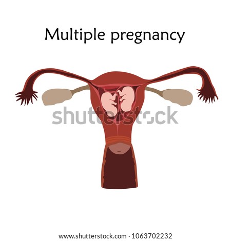 Multiple pregnancy, twins, embryo, fetus in uterus, placenta, umbilical cord. Vector flat medical illustration. Colored image, white background.