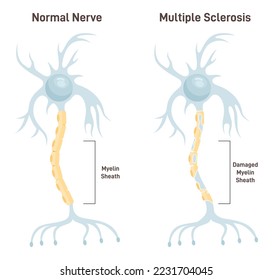 Multiple sclerosis. Autoimmune disease affecting the central nervous system. Myelin sheath of brain and spinal cord nerves are damaged by human immune system. Flat vector illustration