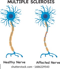 Multiple Sclerosis autoimmune disease affects nerves system 