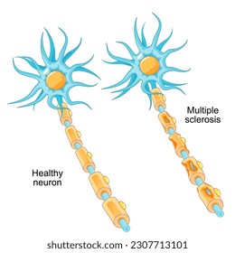 Multiple sclerosis. autoimmune disease. comparison of a healthy neuron and a neuron with a damaged myelin sheath. MS nerve damaged by immune system. Vector illustration