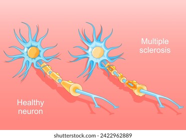 Multiple sclerosis. Autoimmune disease. Normal neuron and a neuron with a damaged myelin sheath. Nerve damage. Isometric Vector. Flat illustration