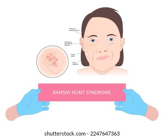 Multiple sclerosis and central motor neuron Infectious face ptosis of bell's cranial chicken pox skin hemiplegia hyperacusis nystagmus simplex otalgia tinnitus