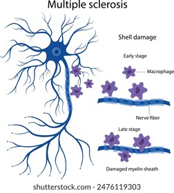 Multiple sclerosis. Damage to the neuron sheath.