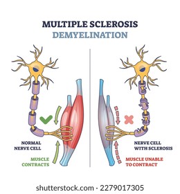 Multiple sclerosis demyelination compared with medical healthy nerves outline diagram. Labeled educational scheme with anatomical and medical autoimmune disease muscle contraction vector illustration