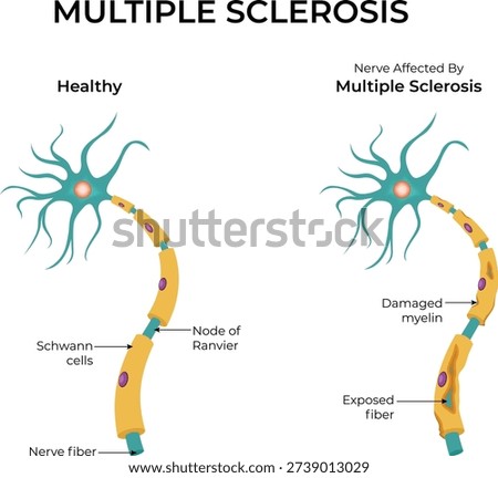 Multiple Sclerosis Healthy vs Affected Nerve Illustration