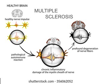 multiple sclerosis. The mechanism of the disease development.