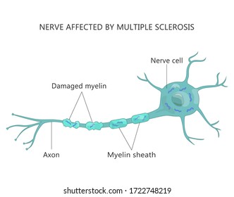 Multiple Sclerosis (MS) - Autoimmune Disease Of The Nerves. Failure Of The Myelin-producing Cells.